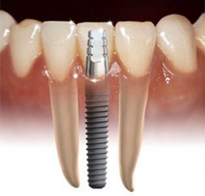 Harga-Biaya-Implant Gigi