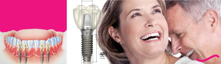 Klinik-Dental-Implant-di-Jakarta